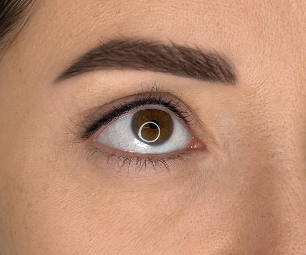 Kundenergebnis: Wimpernkranzverdichtung